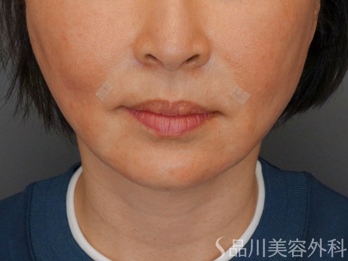 症例NO.70074のAFTER写真