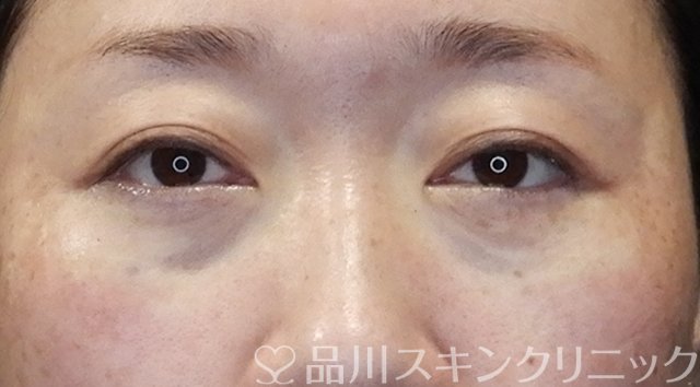 症例NO.64501のAFTER写真