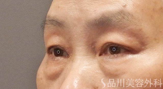 症例NO.73848のBEFORE写真