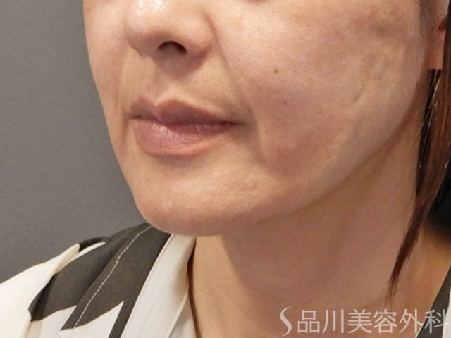 症例NO.71870のAFTER写真