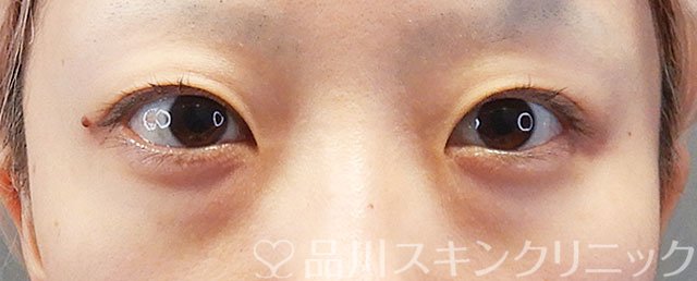 症例NO.72453のBEFORE写真