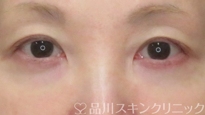 症例NO.71667のBEFORE写真