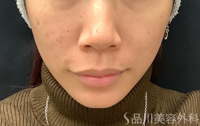 症例NO.67961のAFTER写真