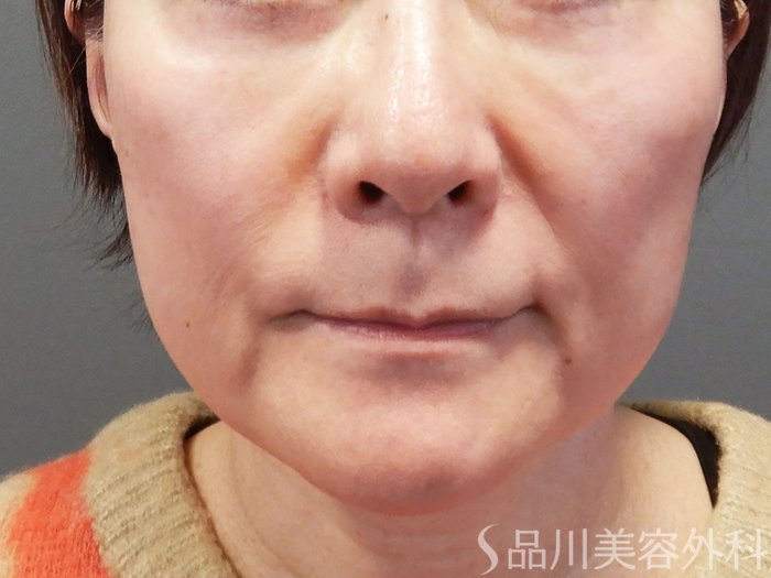 症例NO.73269のBEFORE写真