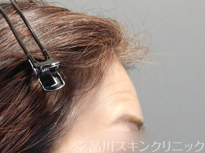 症例NO.72652のBEFORE写真