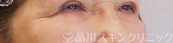 症例NO.70023のAFTER写真