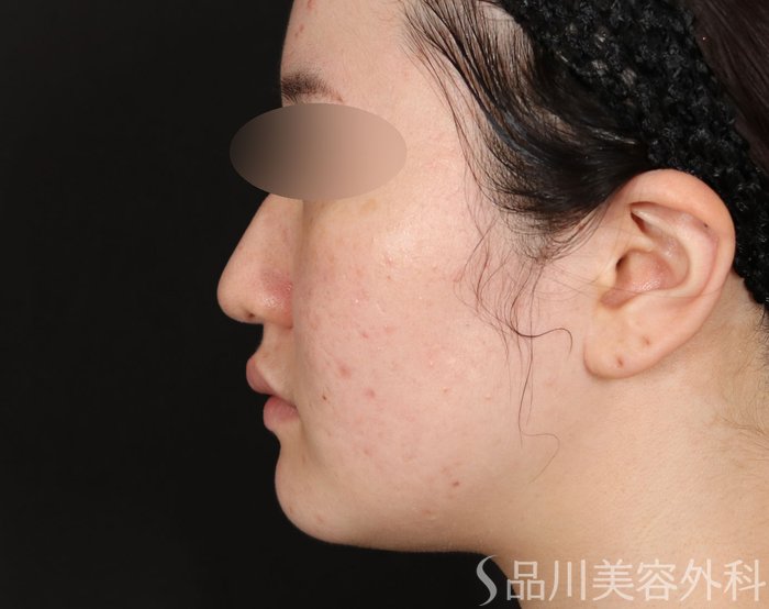 症例NO.71880のBEFORE写真
