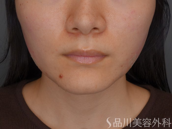 症例NO.72250のAFTER写真