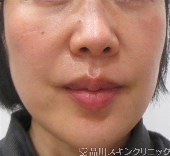 症例NO.25901のAFTER写真