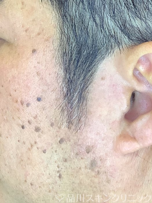 症例NO.65637のBEFORE写真