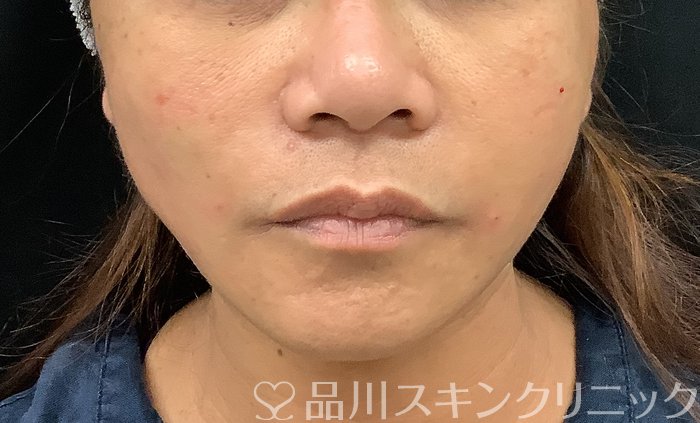 症例NO.69378のAFTER写真