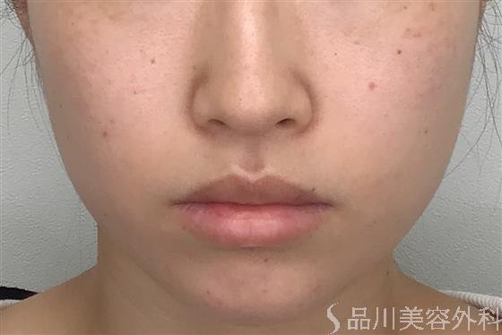 症例NO.55362のAFTER写真