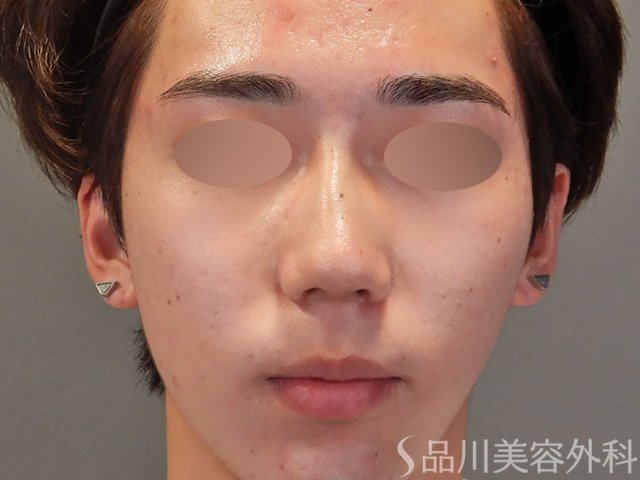 症例NO.74879のAFTER写真