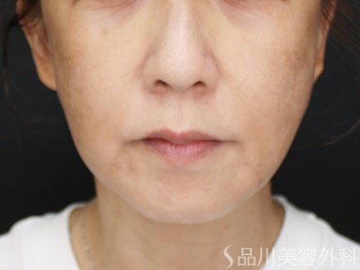 症例NO.71497のAFTER写真