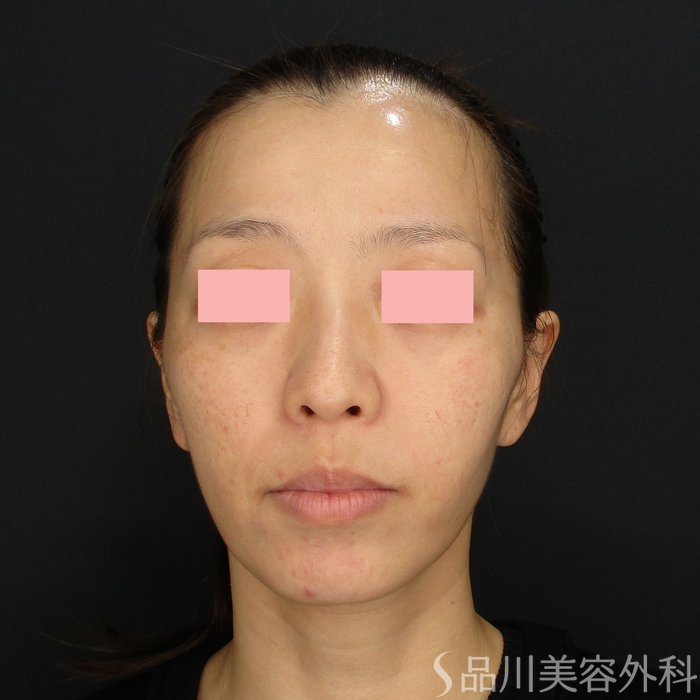 症例NO.71878のBEFORE写真