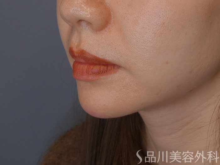 症例NO.72416のAFTER写真