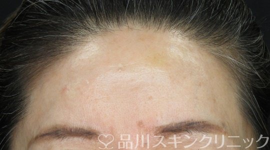 症例NO.70484のAFTER写真