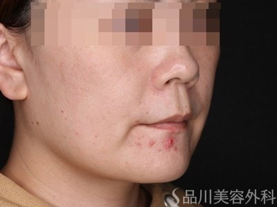 症例NO.70385のAFTER写真