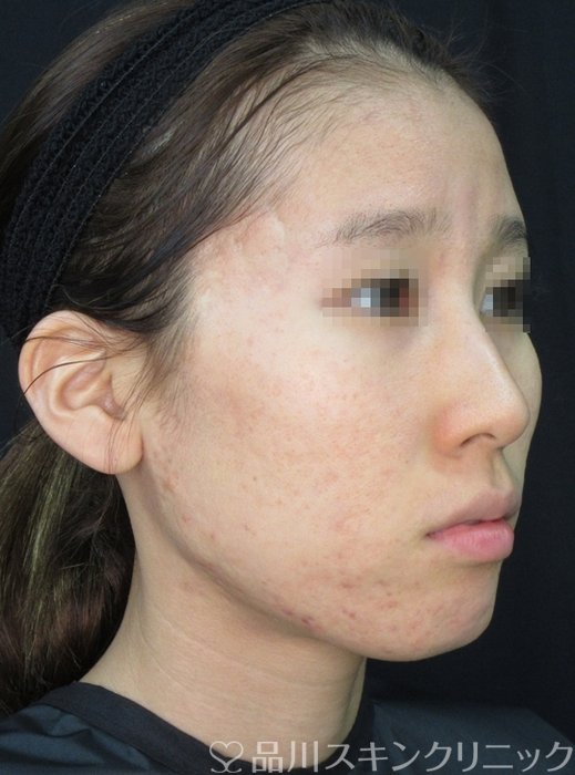 症例NO.72056のAFTER写真