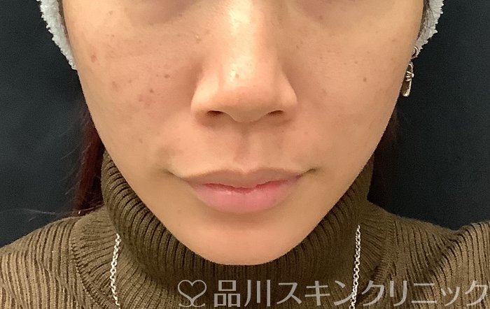 症例NO.67961のAFTER写真