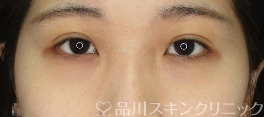 症例NO.64637のAFTER写真