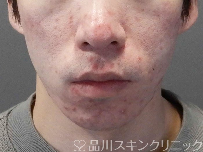 症例NO.66084のBEFORE写真