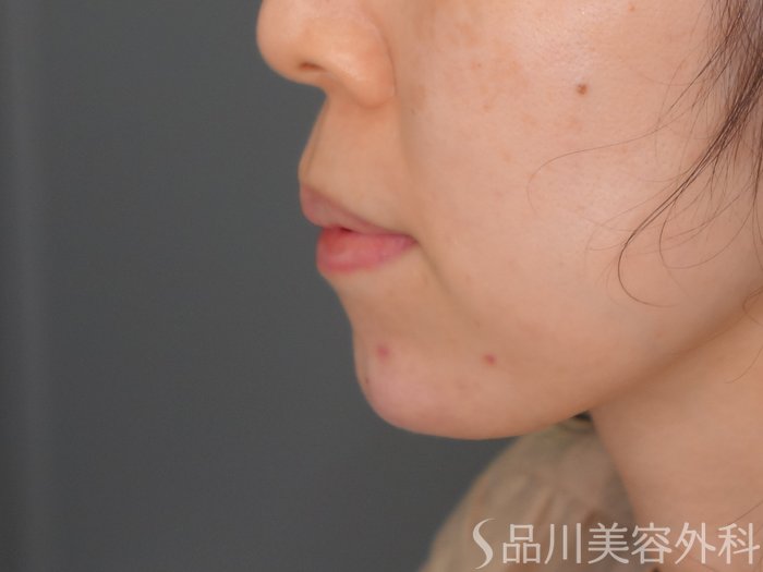 症例NO.70002のAFTER写真