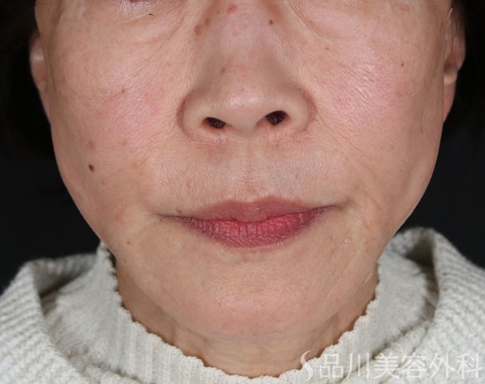 症例NO.72819のAFTER写真