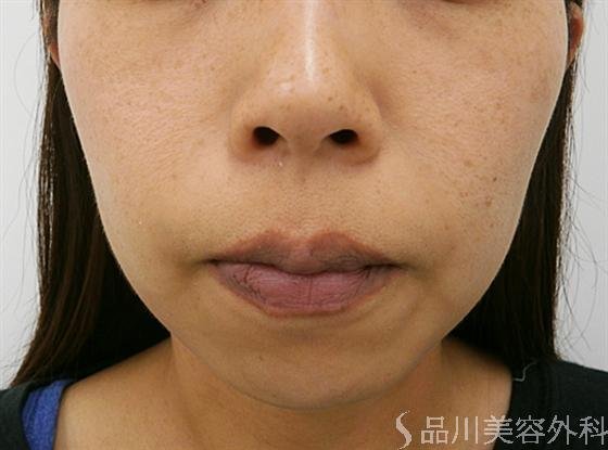 症例NO.14948のAFTER写真