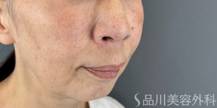 症例NO.69170のBEFORE写真