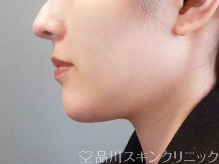 症例NO.72980のAFTER写真