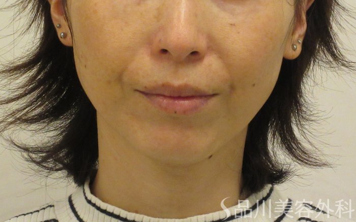 症例NO.72917のBEFORE写真