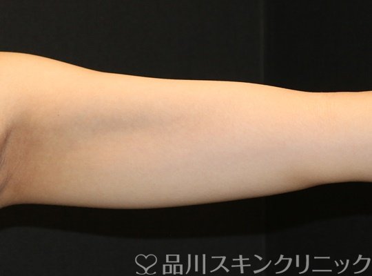 症例NO.71795のAFTER写真
