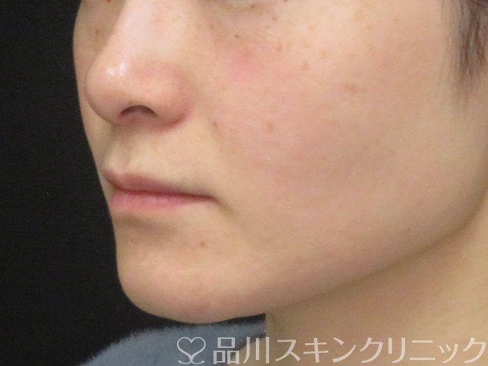 症例NO.74266のAFTER写真