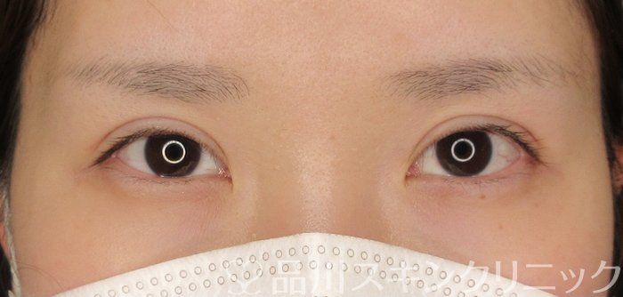 症例NO.69894のAFTER写真