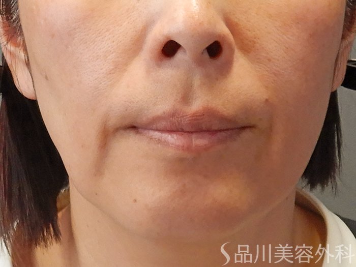 症例NO.70288のBEFORE写真