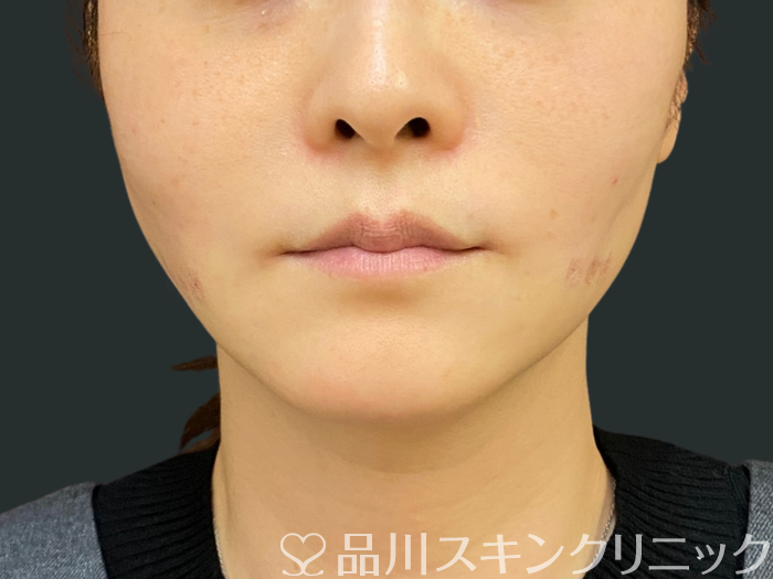 症例NO.74300のAFTER写真