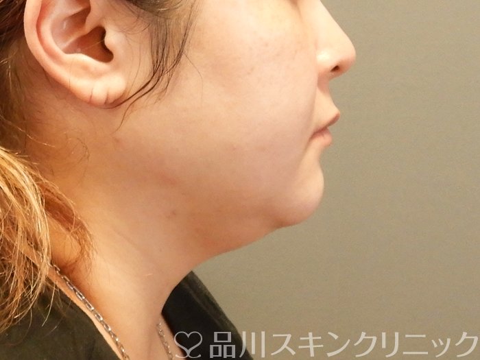 症例NO.66541のBEFORE写真
