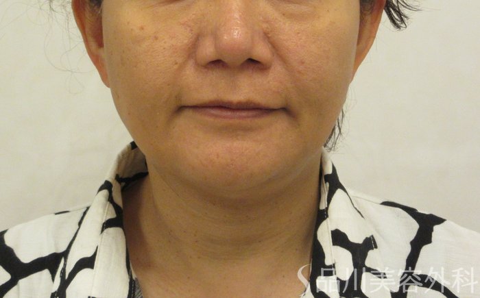 症例NO.72116のBEFORE写真