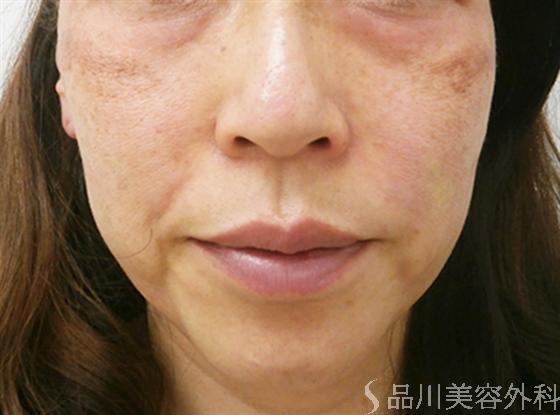 症例NO.13781のAFTER写真