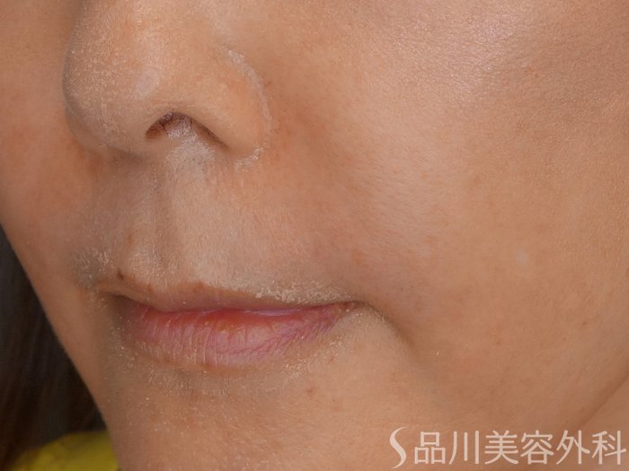症例NO.67480のAFTER写真