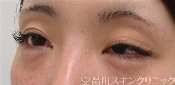 症例NO.41724のBEFORE写真