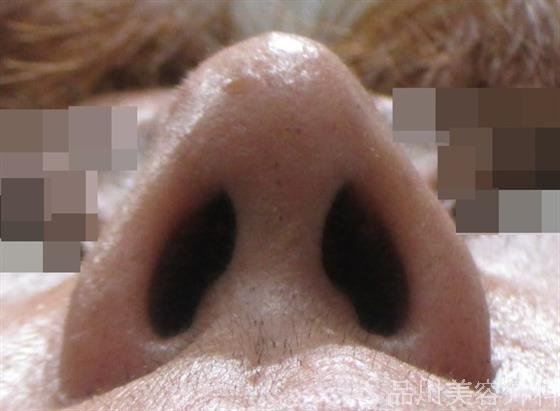 症例NO.22952のAFTER写真