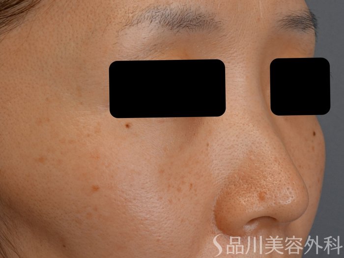 症例NO.73940のBEFORE写真