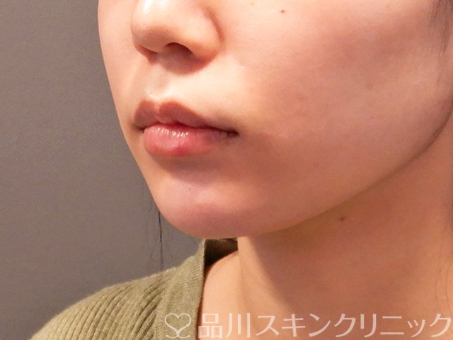 症例NO.69914のAFTER写真