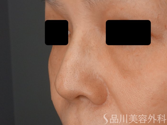 症例NO.62554のAFTER写真