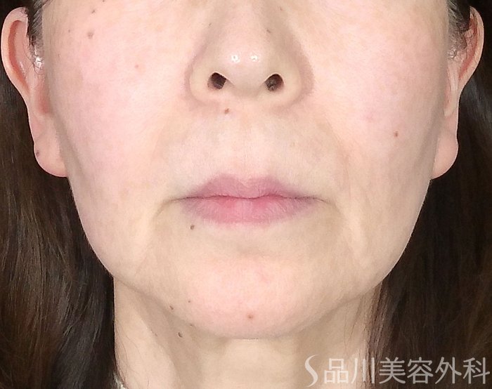 症例NO.69699のBEFORE写真