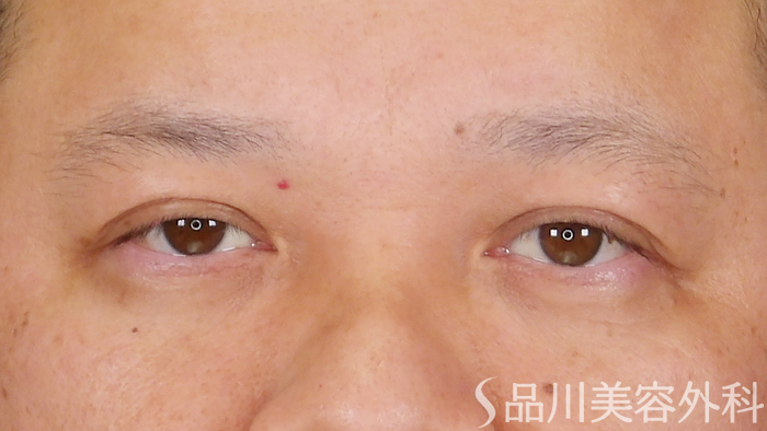 症例NO.70527のAFTER写真