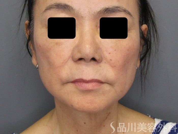 症例NO.74968のBEFORE写真
