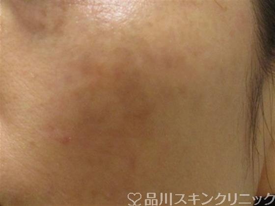 症例NO.38042のAFTER写真
